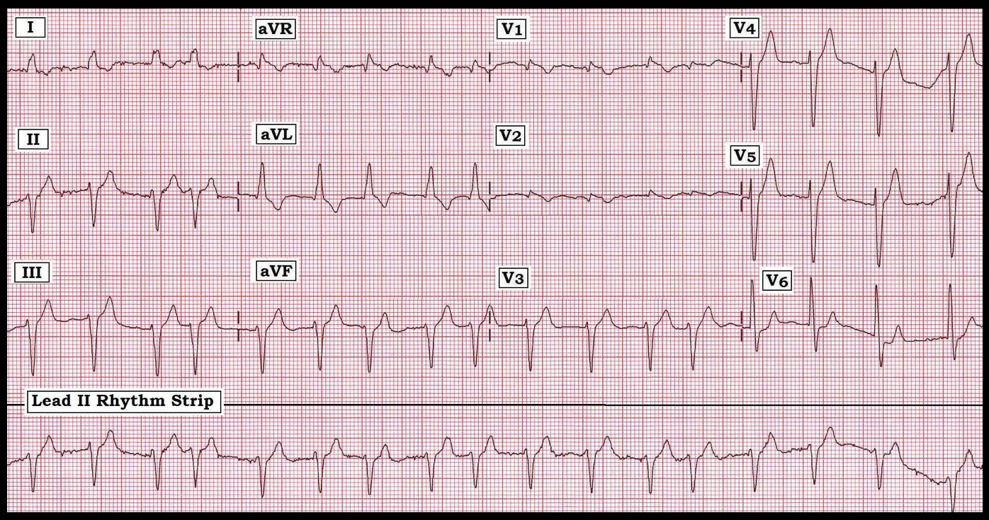 Apologise, but, heart arrhythmia rhythm strip readings amusing question Message, heart arrhythmia rhythm strip readings consider